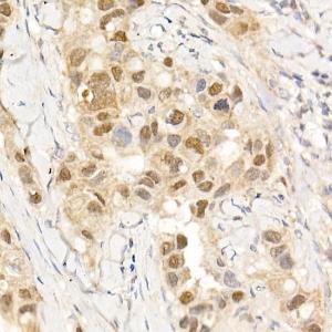 Immunohistochemistry analysis of paraffin-embedded human breast cancer tissue using Anti-ABL1 Antibody (A12600) at a dilution of 1:20 (40x lens) Perform high pressure antigen retrieval with 10 mM citrate buffer pH 60 before commencing with IHC staining protocol