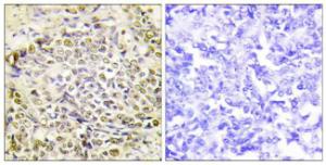 Immunohistochemical analysis of paraffin-embedded human lung carcinoma tissue using Anti-IRX2 Antibody. The right hand panel represents a negative control, where the antibody was pre-incubated with the immunising peptide