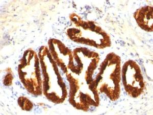 Immunohistochemical analysis of formalin-fixed, paraffin-embedded human prostate carcinoma using Anti-Cytokeratin 18 Antibody [Cocktail KRT18]