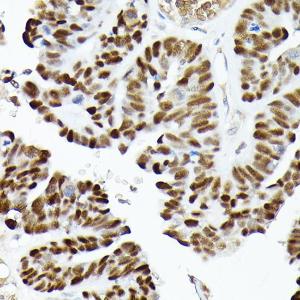 Immunohistochemistry analysis of paraffin-embedded human oophoroma using Anti-p53 Antibody (A307214) at a dilution of 1:200 (40x lens) Perform high pressure antigen retrieval with 10 mM citrate buffer pH 60 before commencing with IHC staining protocol