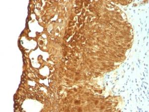 Immunohistochemical analysis of formalin-fixed, paraffin-embedded human cervical carcinoma using Anti-Cytokeratin 19 Antibody [KRT19/799]