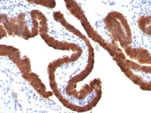 Immunohistochemical analysis of formalin-fixed, paraffin-embedded human ovarian carcinoma using Anti-Cytokeratin 19 Antibody [KRT19/799]