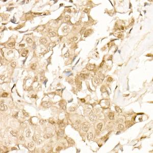 Immunohistochemistry analysis of paraffin-embedded human breast cancer tissue using Anti-beta Catenin Antibody (A12611) at dilution of 20 (40x lens)