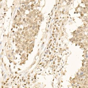 Immunohistochemistry analysis of paraffin-embedded human small cell lung cancer using Anti-beta Catenin Antibody (A12611) at dilution of 20 (40x lens)