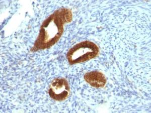 Immunohistochemical analysis of formalin-fixed, paraffin-embedded human endometrial carcinoma using Anti-Cytokeratin 19 Antibody [KRT19/799]