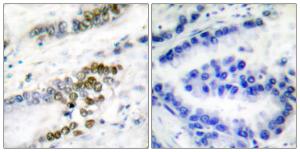 Immunohistochemical analysis of paraffin-embedded human lung carcinoma tissue using Anti-ERCC1 Antibody. The right hand panel represents a negative control, where the antibody was pre-incubated with the immunising peptide