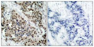 Immunohistochemical analysis of paraffin-embedded human breast carcinoma using Anti-FKHR (phospho Ser256) Antibody. The right hand panel represents a negative control, where the Antibody was pre-incubated with the immunising peptide