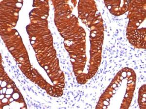 Immunohistochemical analysis of formalin-fixed, paraffin-embedded colon carcinoma using Anti-Cytokeratin 19 Antibody [A53-B/A2.26]