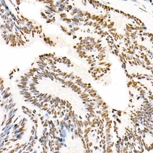 Immunohistochemistry analysis of paraffin-embedded human colon carcinoma tissue using Anti-hnRNP A2B1 Antibody (A307245) at a dilution of 1:20 (40X lens). Perform high pressure antigen retrieval with 10 mM citrate buffer pH 6.0 before commencing with IHC staining protocol