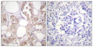 Immunohistochemical analysis of paraffin-embedded human breast carcinoma using Anti-CDK7 (phospho Thr170) Antibody. The right hand panel represents a negative control, where the antibody was pre-incubated with the immunising peptide