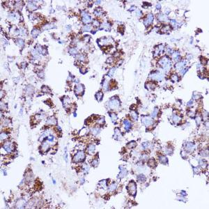 Immunohistochemistry analysis of paraffin-embedded human liver cancer using Anti-SHMT2/SHMT Antibody (A308252) at a dilution of 1:100 (40X lens). Perform microwave antigen retrieval with 10 mM PBS buffer pH 7.2 before commencing with IHC staining protocol