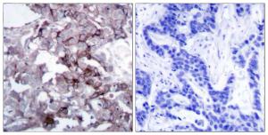 Immunohistochemical analysis of paraffin-embedded human breast carcinoma tissue using Anti-EGFR Antibody The right hand panel represents a negative control, where the antibody was pre-incubated with the immunising peptide