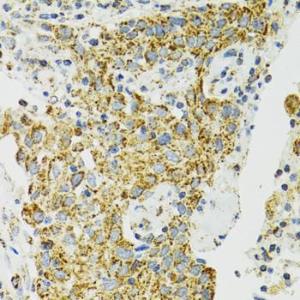 Immunohistochemistry analysis of paraffin-embedded human lung cancer using Anti-Grp75/MOT Antibody (A12650) at a dilution of 1:100 (40X lens). Perform microwave antigen retrieval with 10 mM PBS buffer pH 7.2 before commencing with IHC staining protocol