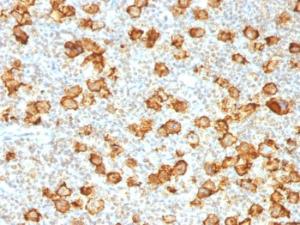 Immunohistochemical analysis of formalin-fixed, paraffin-embedded human Hodgkin's lymphoma using Anti-CD30 Antibody [Ki-1/1505R]