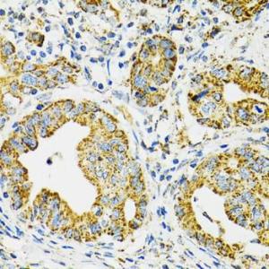 Immunohistochemistry analysis of paraffin-embedded human gastric cancer using Anti-Grp75/MOT Antibody (A12650) at a dilution of 1:100 (40X lens). Perform microwave antigen retrieval with 10 mM PBS buffer pH 7.2 before commencing with IHC staining protocol