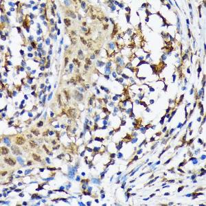 Immunohistochemistry analysis of paraffin-embedded human esophageal cancer using Anti-CAMKIV Antibody [ARC1506] (A305710) at a dilution of 1:100 (40x lens) Perform microwave antigen retrieval with 10 mM Tris/EDTA buffer pH 90 before commencing with IHC staining protocol