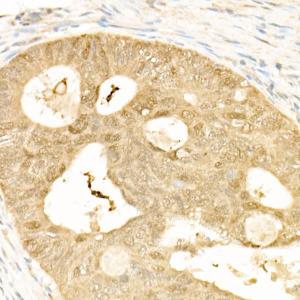 Immunohistochemistry analysis of paraffin-embedded human colon carcinoma tissue using Anti-YAP1 Antibody (A308257) at a dilution of 1:20 (40x lens). Perform high pressure antigen retrieval with 10 mM citrate buffer pH 6.0 before commencing with IHC staining protocol.