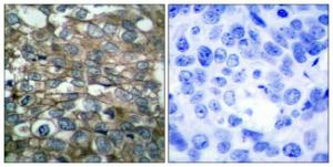 Immunohistochemical analysis of paraffin-embedded human breast carcinoma tissue using Anti-EGFR Antibody The right hand panel represents a negative control, where the antibody was pre-incubated with the immunising peptide