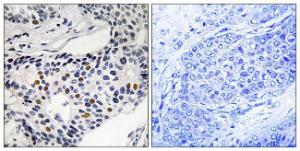 Immunohistochemical analysis of paraffin-embedded human breast carcinoma using Anti-WEE1 (phospho Ser53) Antibody. The right hand panel represents a negative control, where the antibody was pre-incubated with the immunising peptide.