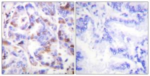 Immunohistochemical analysis of paraffin-embedded human lung carcinoma using Anti-RFA2 (phospho Thr21) Antibody. The right hand panel represents a negative control, where the antibody was pre-incubated with the immunising peptide