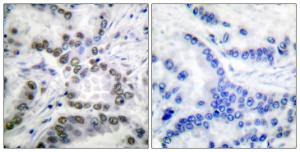 Immunohistochemical analysis of paraffin-embedded human lung carcinoma tissue using Anti-CBP (acetyl Lys1535) Antibody. The right hand panel represents a negative control, where the antibody was pre-incubated with the immunising peptide