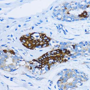 Immunohistochemistry analysis of paraffin-embedded human mammary cancer using Anti-EEA1 Antibody (A12659) at a dilution of 1:100 (40x lens). Perform microwave antigen retrieval with 10 mM PBS buffer pH 7.2 before commencing with IHC staining protocol.