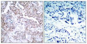 Immunohistochemical analysis of paraffin-embedded human breast carcinoma using Anti-p53 (phospho Ser15) Antibody. The right hand panel represents a negative control, where the antibody was pre-incubated with the immunising peptide