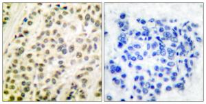 Immunohistochemical analysis of paraffin-embedded human breast carcinoma tissue using Anti-DP-1 Antibody. The right hand panel represents a negative control, where the antibody was pre-incubated with the immunising peptide