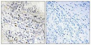 Immunohistochemical analysis of paraffin-embedded human lung cancer using Anti-CDC7 Antibody 1:100 (4°C overnight). The right hand panel represents a negative control, where the antibody was pre-incubated with the immunising peptide.