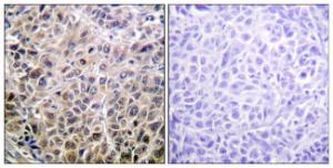 Immunohistochemical analysis of paraffin-embedded human liver carcinoma tissue using Anti-DAPK1 Antibody. The right hand panel represents a negative control, where the Antibody was pre-incubated with the immunising peptide