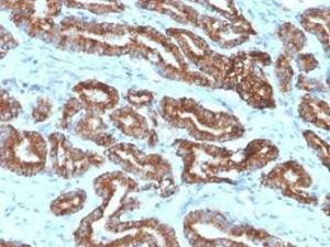 Immunohistochemical analysis of formalin-fixed, paraffin-embedded human prostate carcinoma tissue using Anti-AMACR Antibody [13H4]