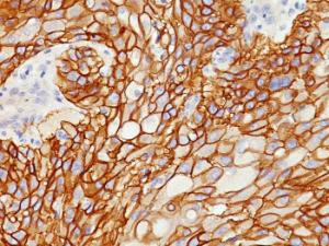 Immunohistochemical analysis of formalin-fixed, paraffin-embedded human lung squamous cell carcinoma using Anti-EGFR Antibody [GFR/1708]