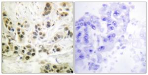 Immunohistochemical analysis of paraffin-embedded human breast carcinoma using Anti-Lamin A + C (phospho Ser392) Antibody. The right hand panel represents a negative control, where the antibody was pre-incubated with the immunising peptide.