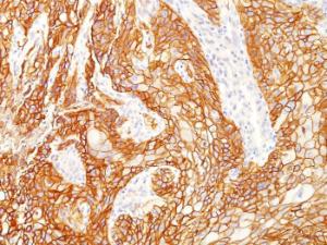 Immunohistochemical analysis of formalin-fixed, paraffin-embedded human lung squamous cell carcinoma using Anti-EGFRvIII Antibody [GFR/2600R]