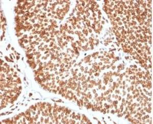 Immunohistochemical analysis of formalin-fixed, paraffin-embedded human bladder carcinoma tissue using Anti-TCF4 Antibody [TCF4/2252] at 2 µg/ml