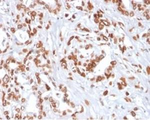 Immunohistochemical analysis of formalin-fixed, paraffin-embedded human breast carcinoma tissue using Anti-TCF4 Antibody [TCF4/2252] at 2 µg/ml