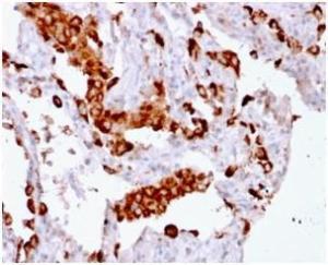 Immunohistochemical analysis of formalin-fixed, paraffin-embedded human lung adenocarcinoma using Anti-NAPSIN A Antibody [rNAPSA/1239]