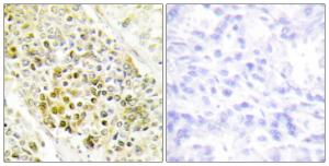 Immunohistochemical analysis of paraffin-embedded human lung carcinoma tissue using Anti-DLX5 Antibody. The right hand panel represents a negative control, where the antibody was pre-incubated with the immunising peptide