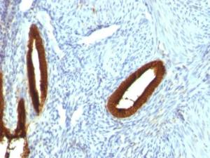 Immunohistochemical analysis of formalin-fixed, paraffin-embedded human endometrial carcinoma using Anti-Cytokeratin 19 Antibody [KRT19/800]