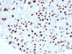 Immunohistochemical analysis of formalin-fixed, paraffin-embedded human colon carcinoma tissue using Anti-p21 Antibody [rCIP1/6907] at 2µg/ml