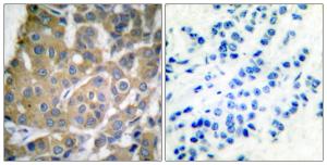 Immunohistochemical analysis of paraffin-embedded human breast carcinoma tissue using Anti-Cox2 Antibody. The right hand panel represents a negative control, where the antibody was pre-incubated with the immunising peptide.