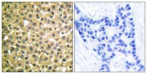 Immunohistochemical analysis of paraffin-embedded human breast carcinoma tissue using Anti-Retinoic Acid Receptor beta Antibody The right hand panel represents a negative control, where the antibody was pre-incubated with the immunising peptide