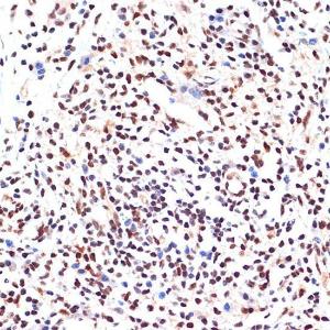 Immunohistochemistry analysis of paraffin-embedded human breast cancer tissue using Anti-PAX9 Antibody [ARC2267] (A307255) at a dilution of 1:100 (40X lens). Perform microwave antigen retrieval with 10 mM Tris/EDTA buffer pH 9.0 before commencing with IHC staining protocol