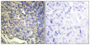 Immunohistochemical analysis of paraffin-embedded human breast carcinoma tissue using Anti-DFFA Antibody. The right hand panel represents a negative control, where the antibody was pre-incubated with the immunising peptide