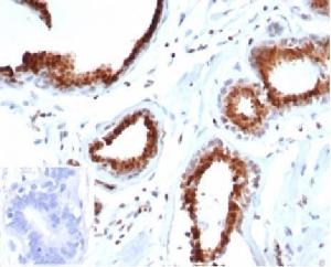 Immunohistochemical analysis of formalin-fixed, paraffin-embedded human breast carcinoma tissue using Anti-p27 Kip1 Antibody [rKIP1/1356]. Inset: PBS instead of the primary antibody. Secondary antibody negative control