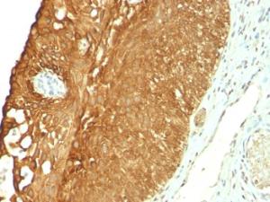 Immunohistochemical analysis of formalin-fixed, paraffin-embedded human cervical carcinoma using Anti-Cytokeratin 19 Antibody [KRT19/800]