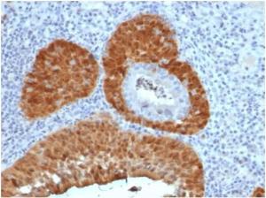 Immunohistochemical analysis of formalin-fixed, paraffin-embedded human cervix tissue using Anti-p16INK4a Antibody [rCDKN2A/4845]