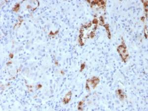 Immunohistochemical analysis of formalin-fixed, paraffin-embedded human lung adenocarcinoma using Anti-NAPSIN A Antibody [NAPSA/3307]