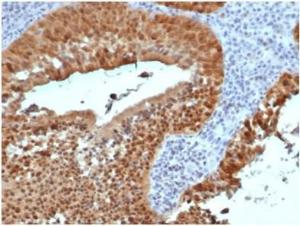 Immunohistochemical analysis of formalin-fixed, paraffin-embedded human cervix tissue using Anti-p16INK4a Antibody [rCDKN2A/4845]