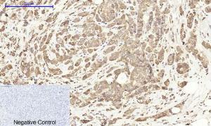 Immunohistochemical analysis of paraffin-embedded human breast cancer tissue using Anti-Cox2 Antibody at 1:200 (4°C overnight). Negative control was secondary antibody only.